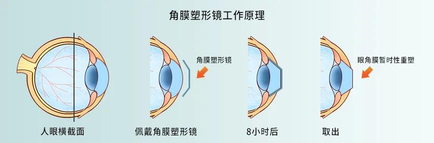 优 点 硬性透气性角膜接触镜&角膜塑形镜 √成型性好,不易变形